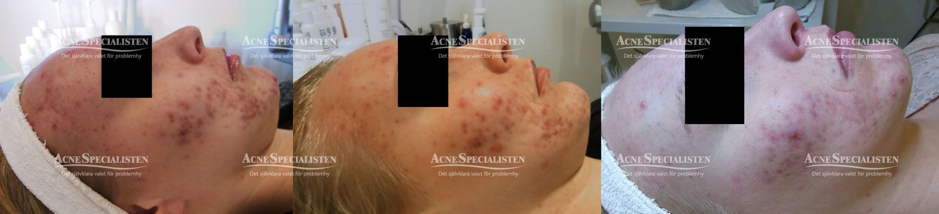 acne kund före och efter bild