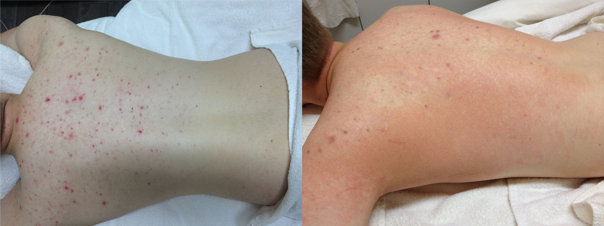 före och efter bilder acne ryggen