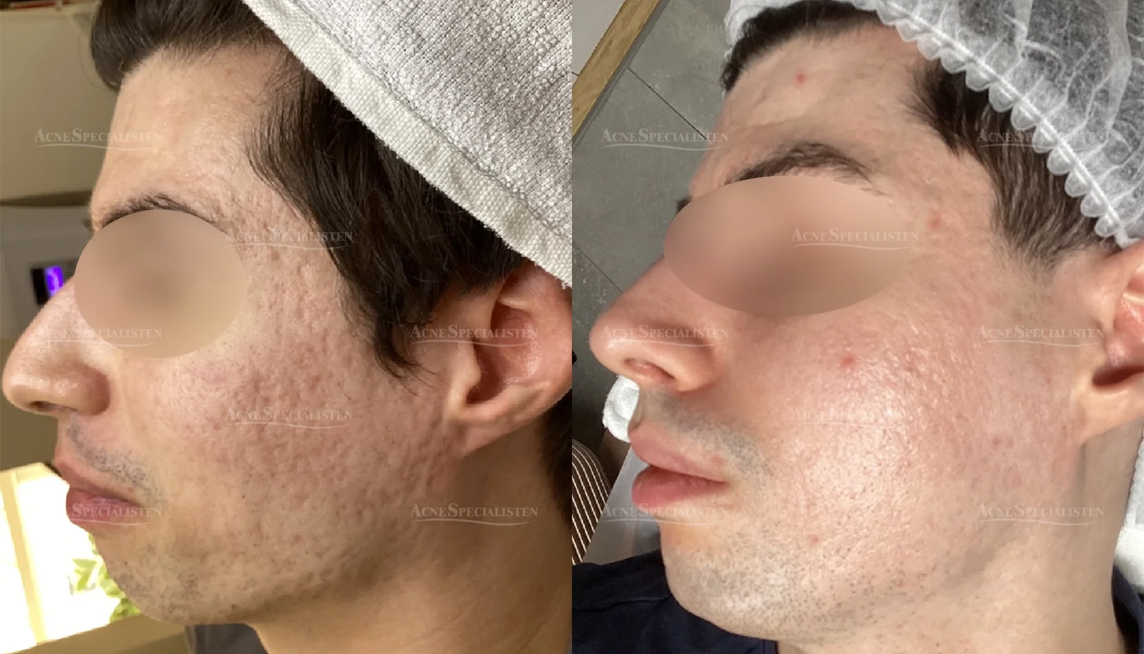 Ärr i ansiktet från vänster sida före och efter behandling