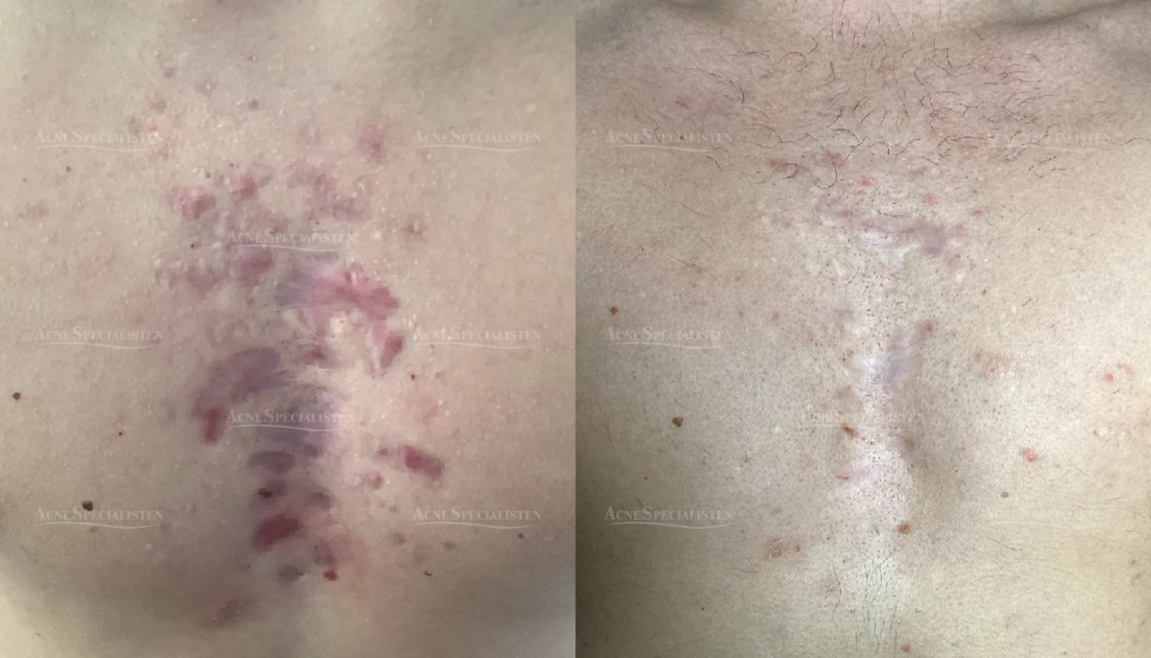 Ärr på bröstet före och efter behandling