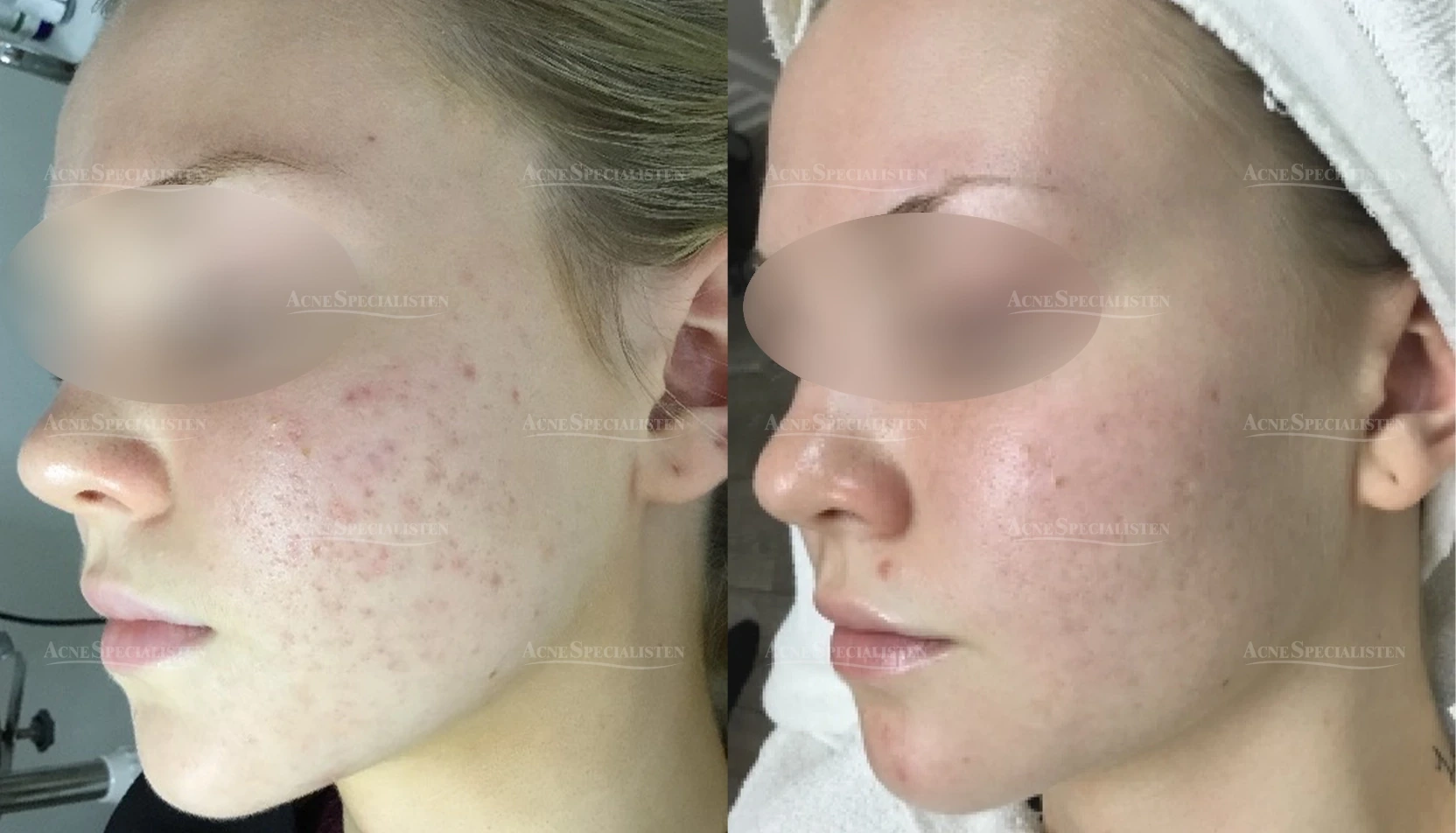 Ärr och fläckar före och efter behandling
