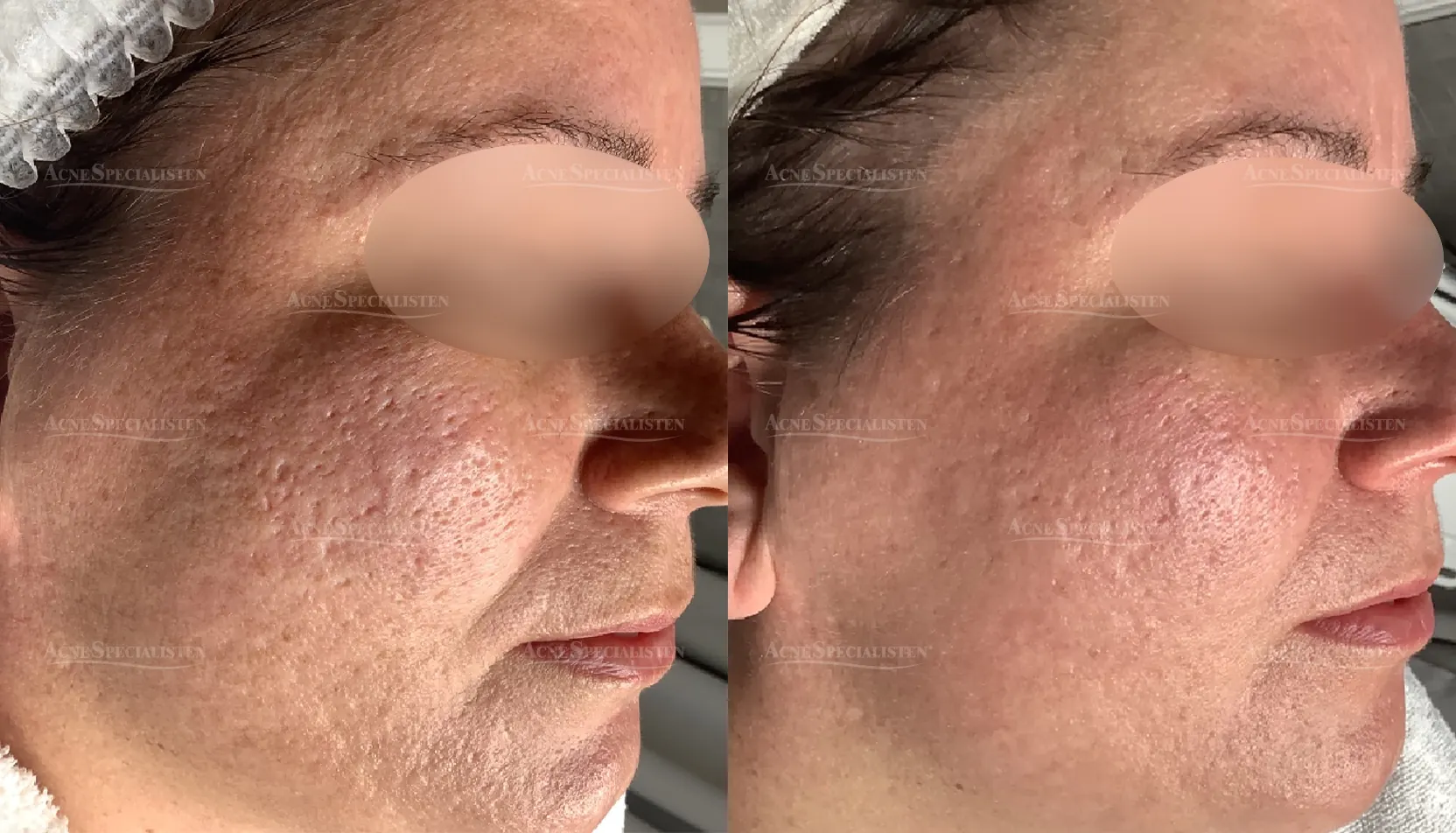 Ärr på kinden före och efter behandling