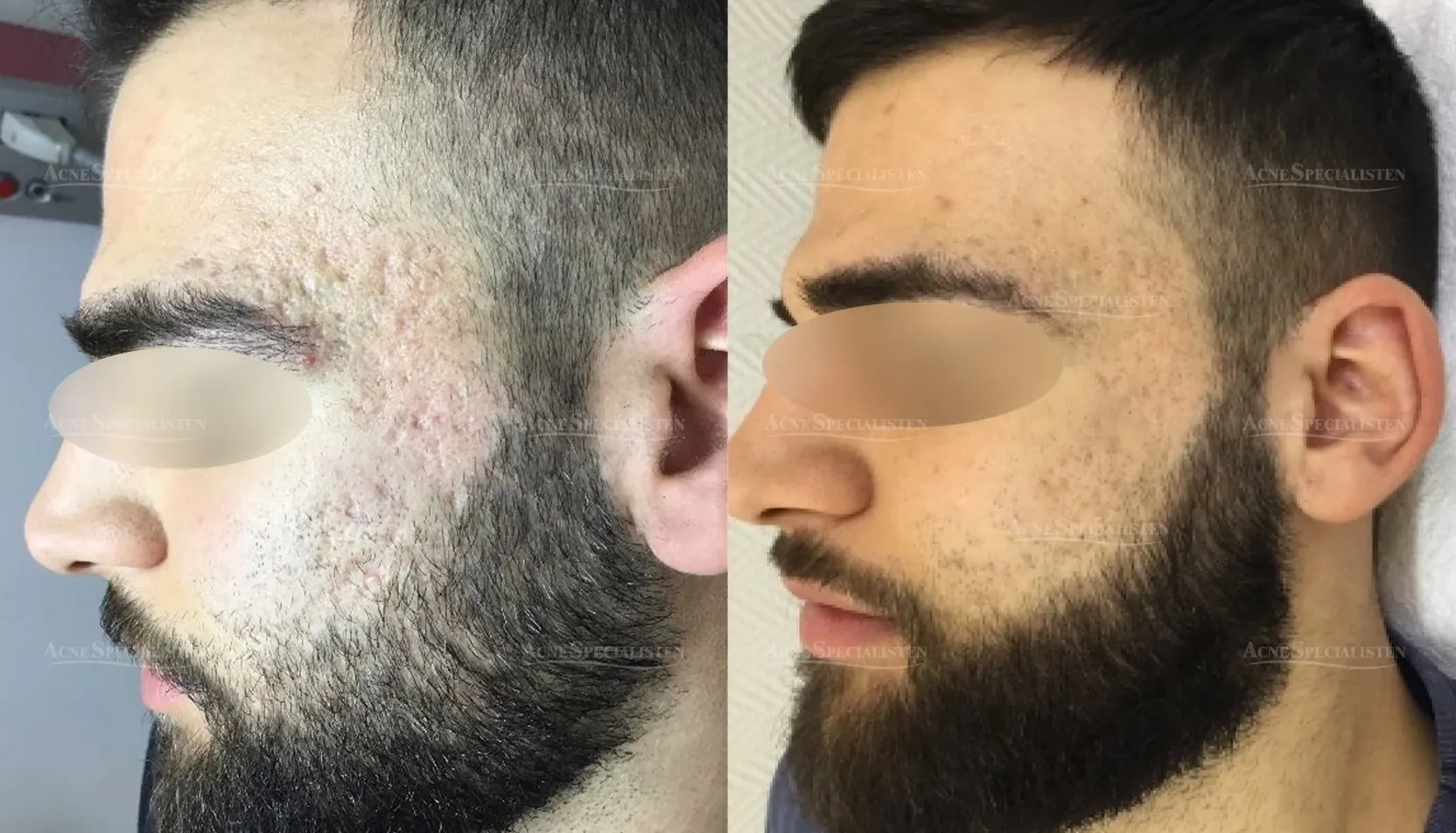 Ärr på tinningen före och efter behandling