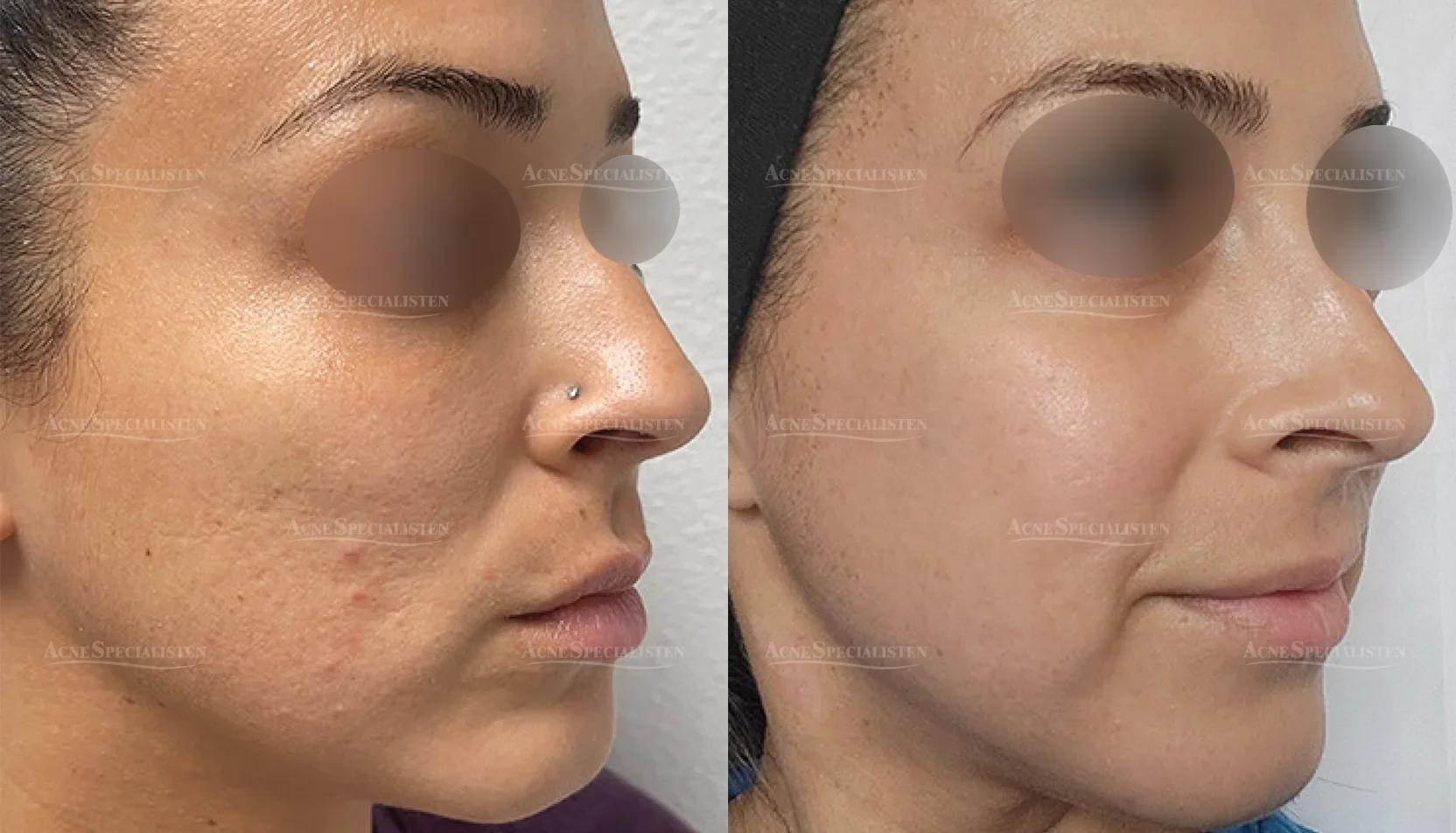 Hudförbättring med CO2-laser före och efter