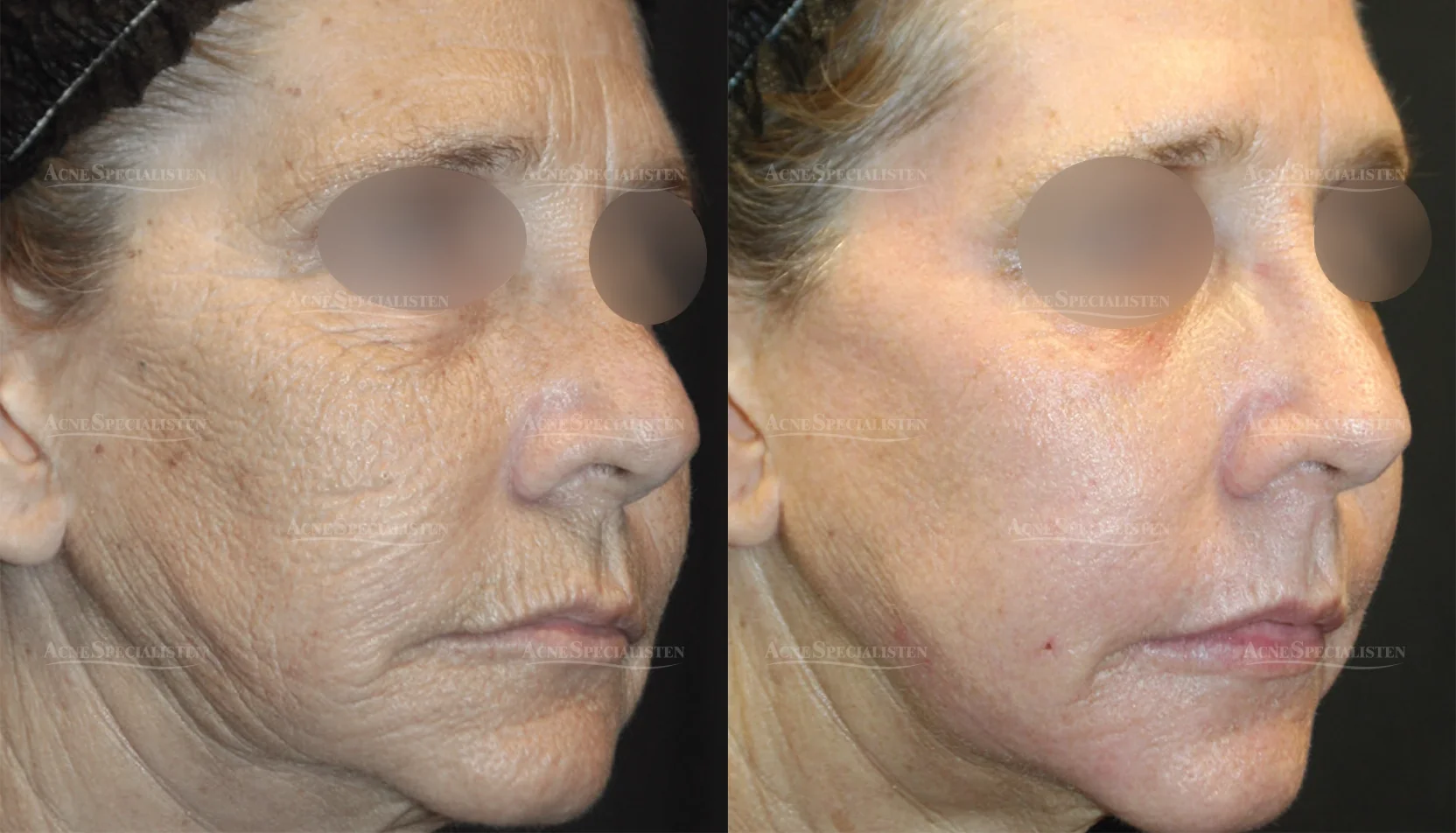 Hudföryngring med CO2-laser före och efter