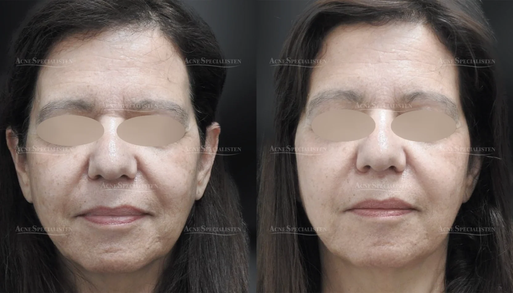 Hudtextur före och efter CO2-laser behandling