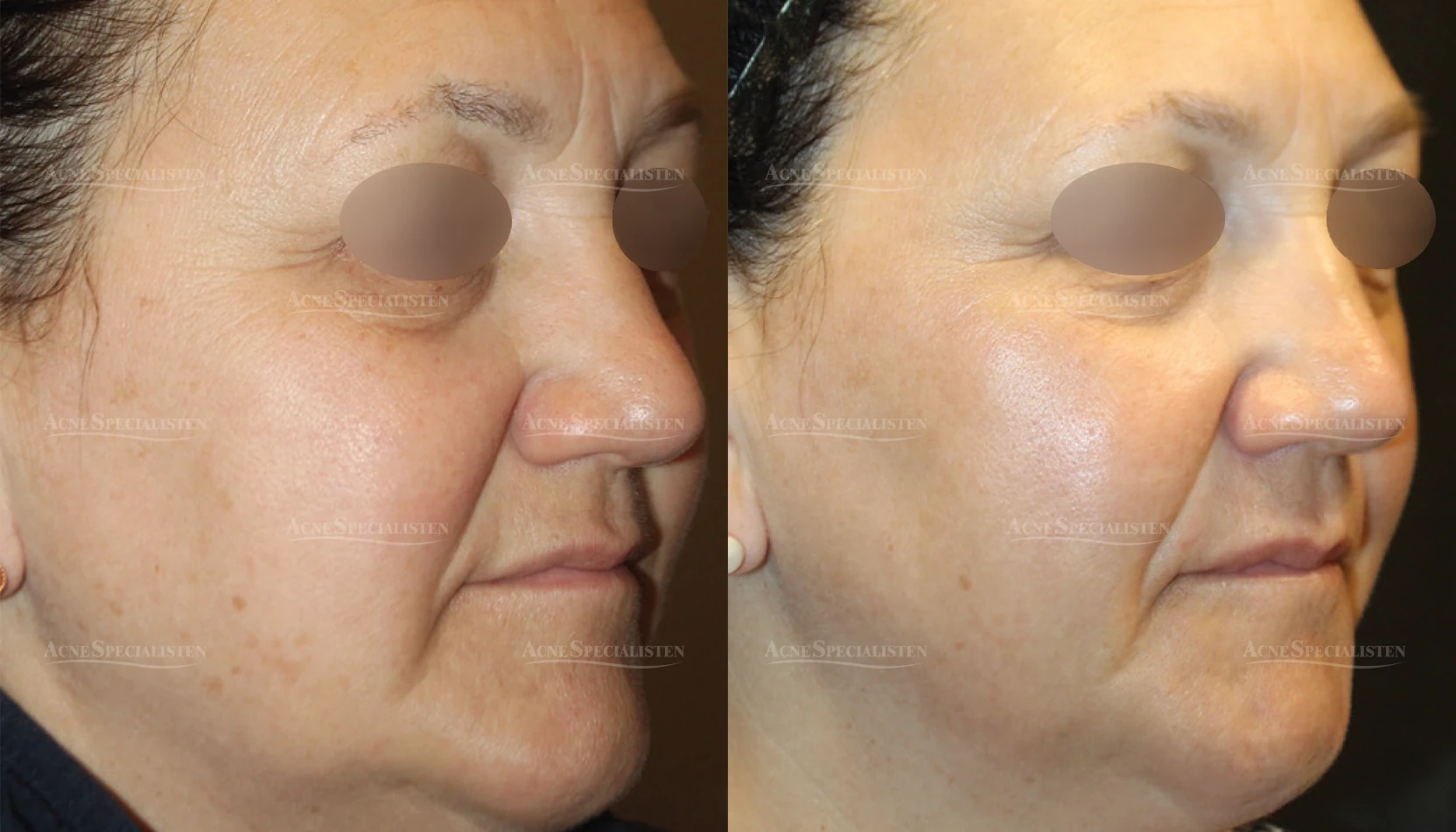 Käklinje och hudtextur före och efter CO2-laser