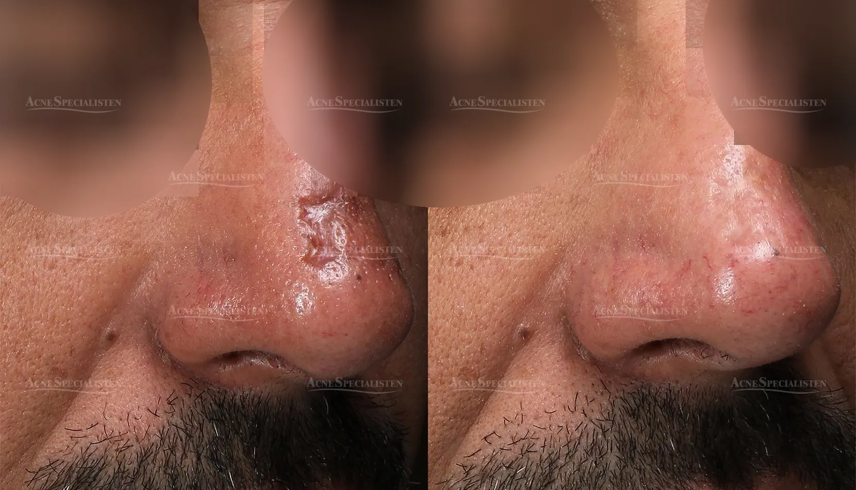CO2-laser behandling av näsan före och efter