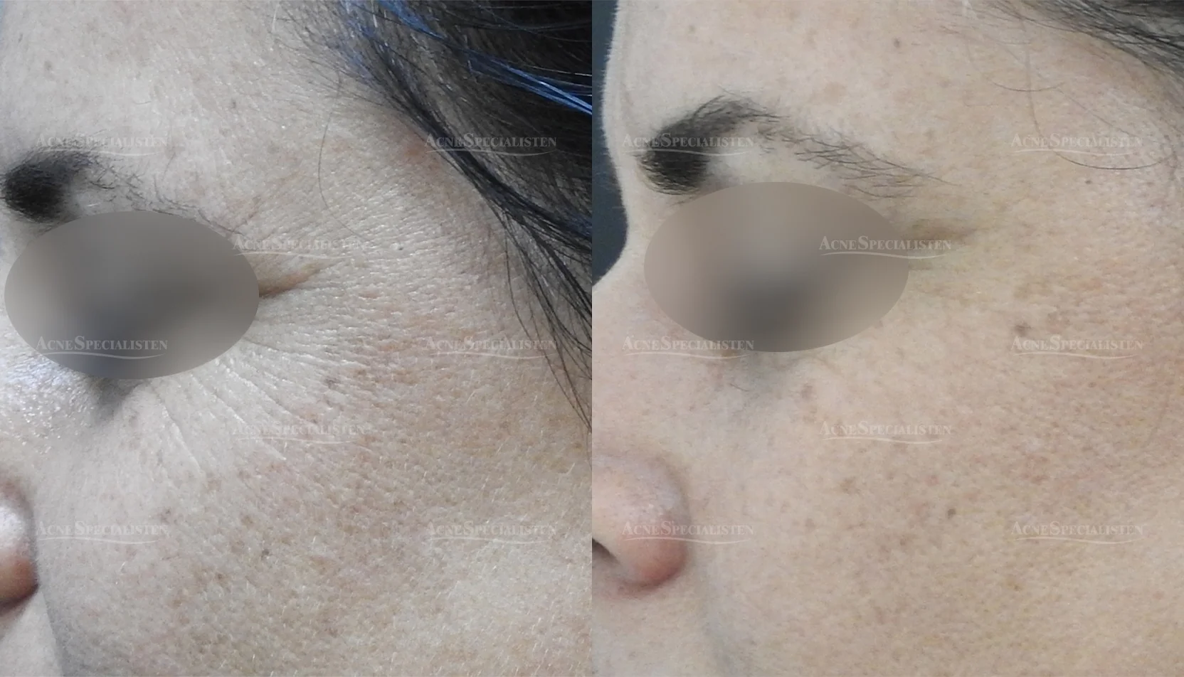 CO2-laser behandling av ögonvrå före och efter