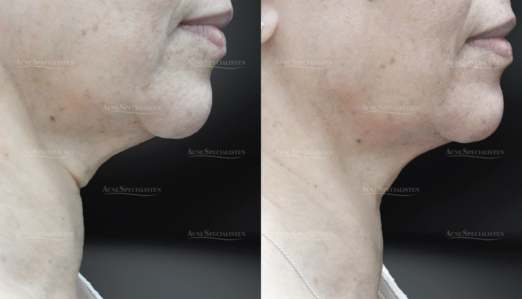 Slapp haka behandlad med CO2-laser före och efter