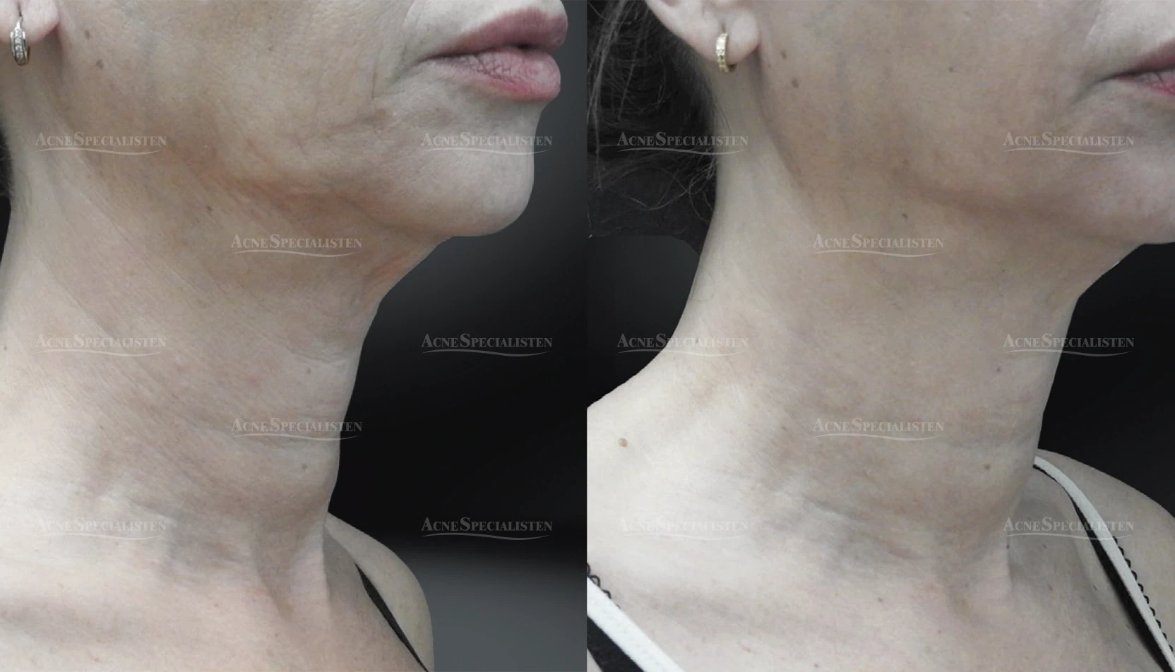 Slapp hals behandlad med CO2-laser före och efter