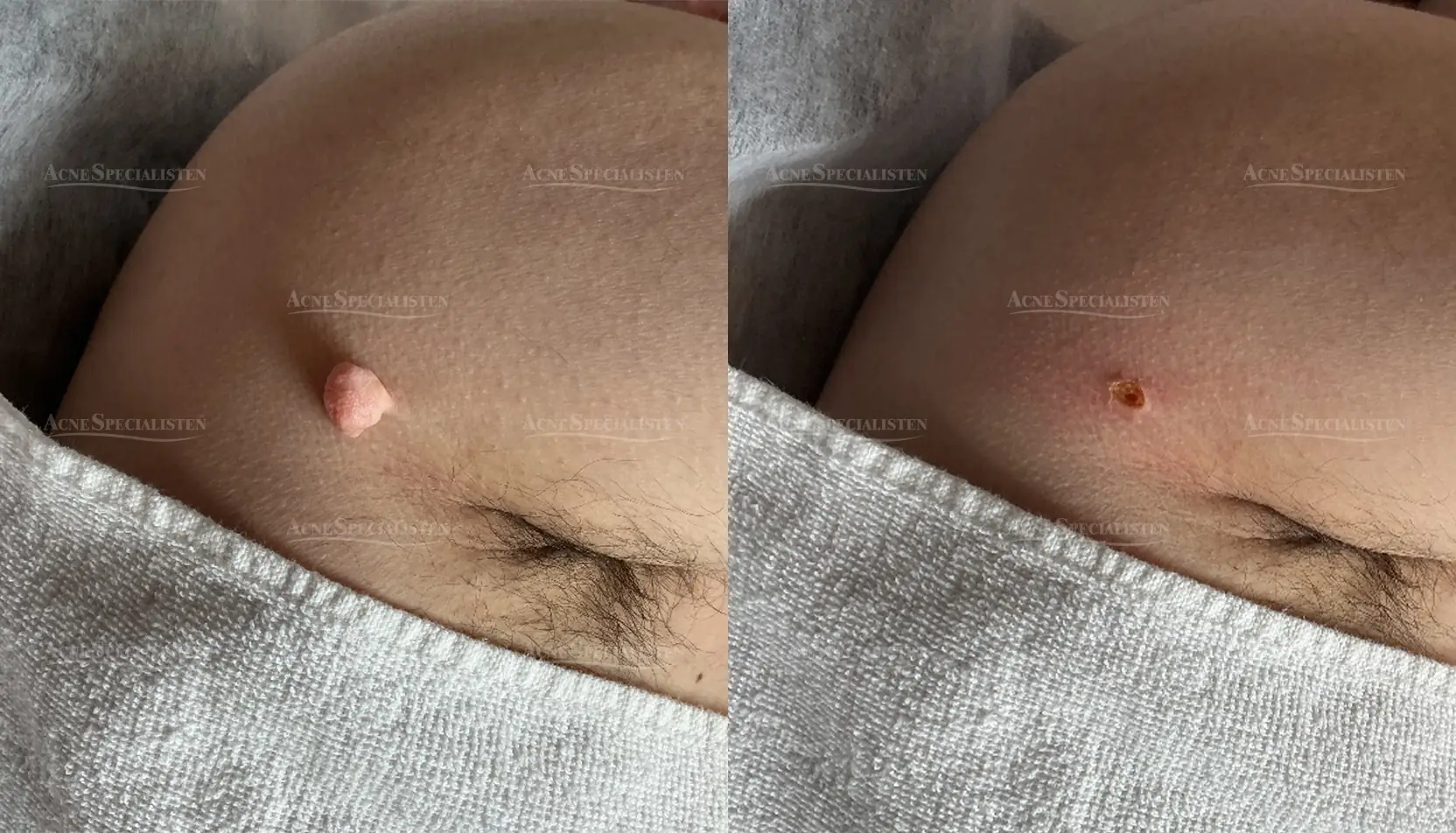 Hudförändring på axeln före och efter behandling