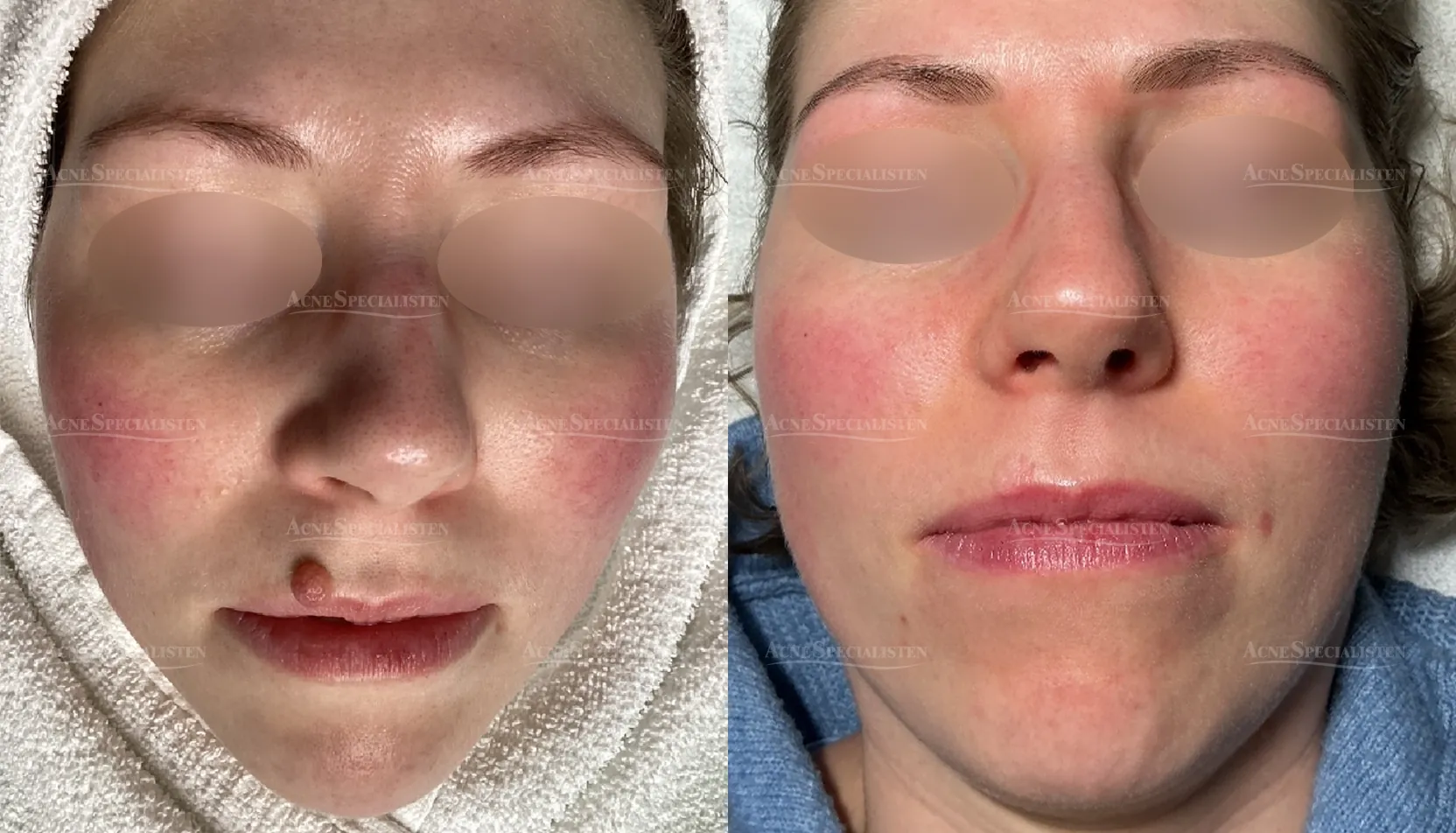 Hudförändring på läppen före och efter behandling