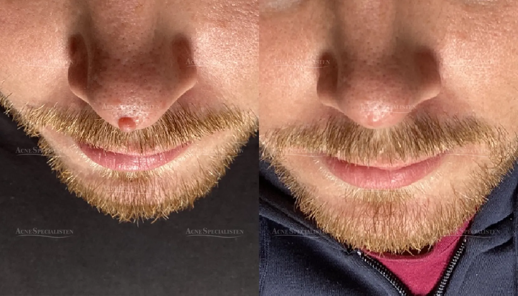 Hudförändring på näsan före och efter behandling