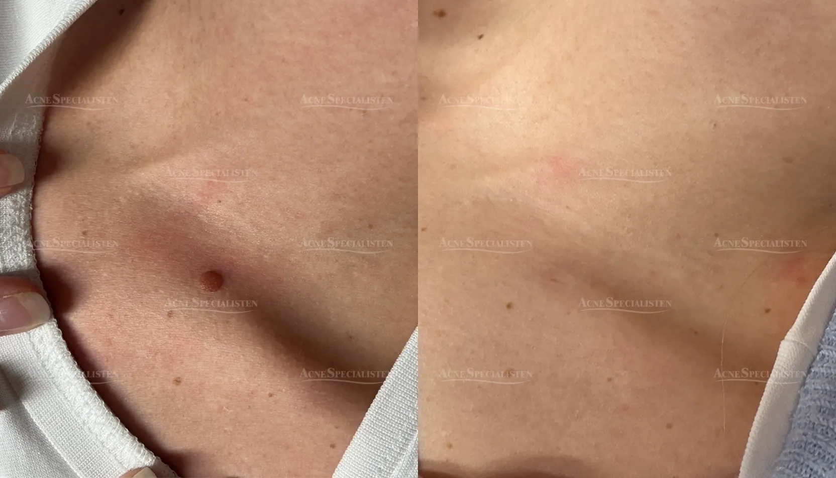 Hudförändringar på nyckelben före och efter CO2-laser