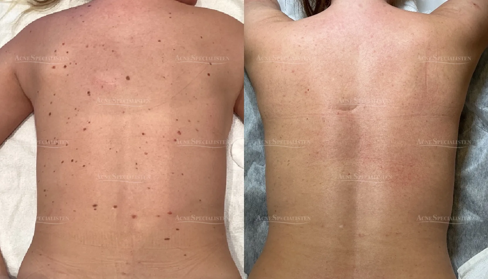 Hudförändring på ryggen före och efter behandling