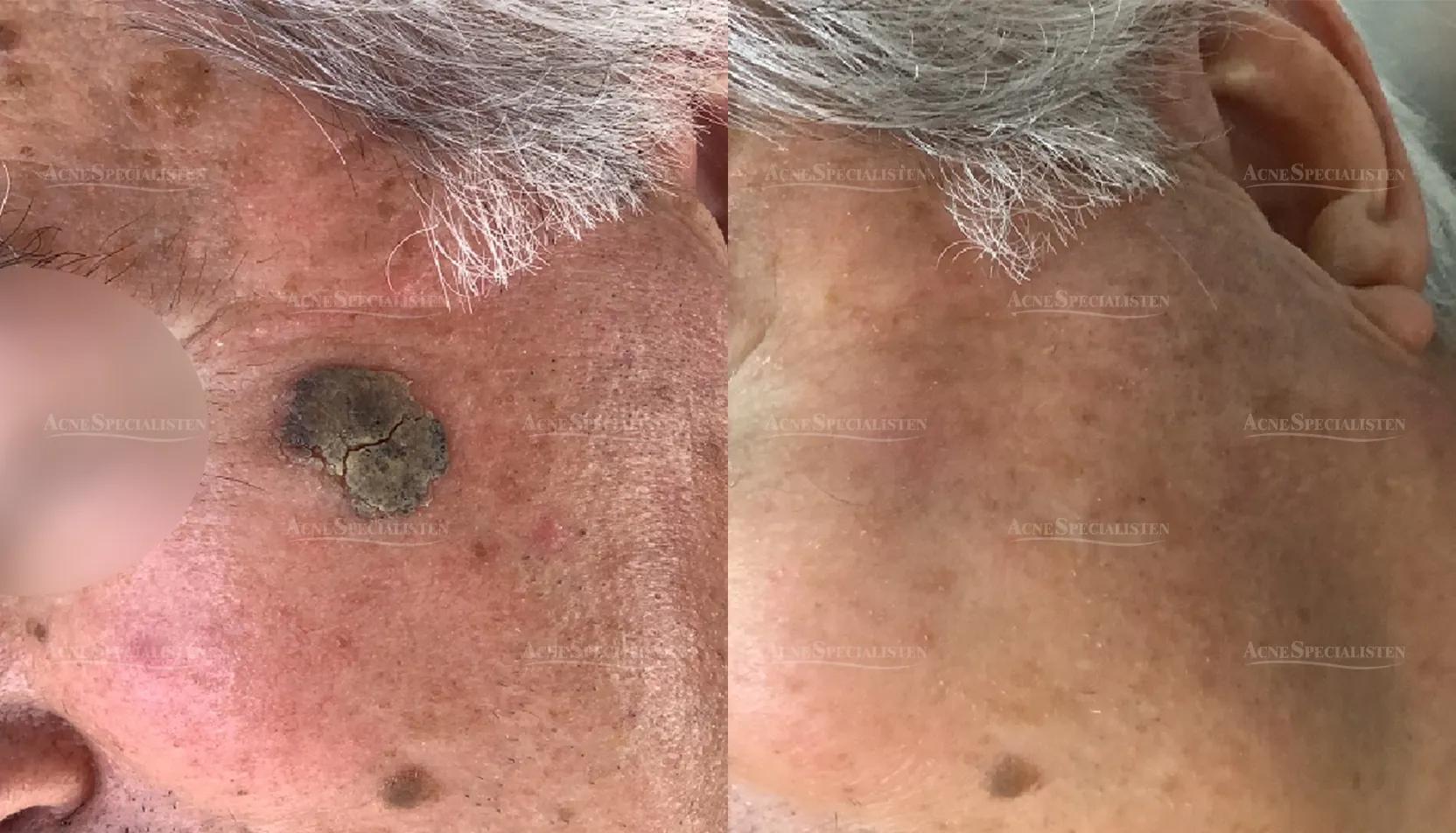 Hudförändring på tinningen före och efter behandling