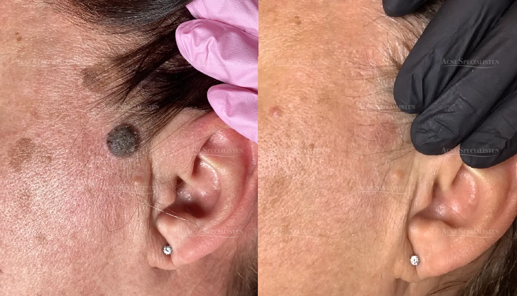 Hudförändring vid örat före och efter behandling