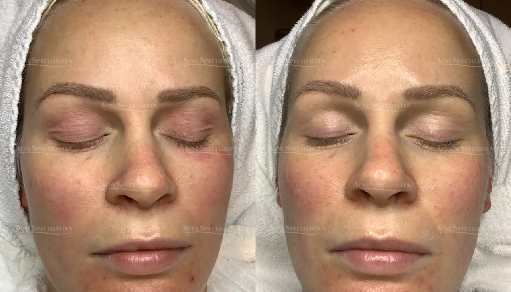 Infuzion behandling av ögonområdet före och efter