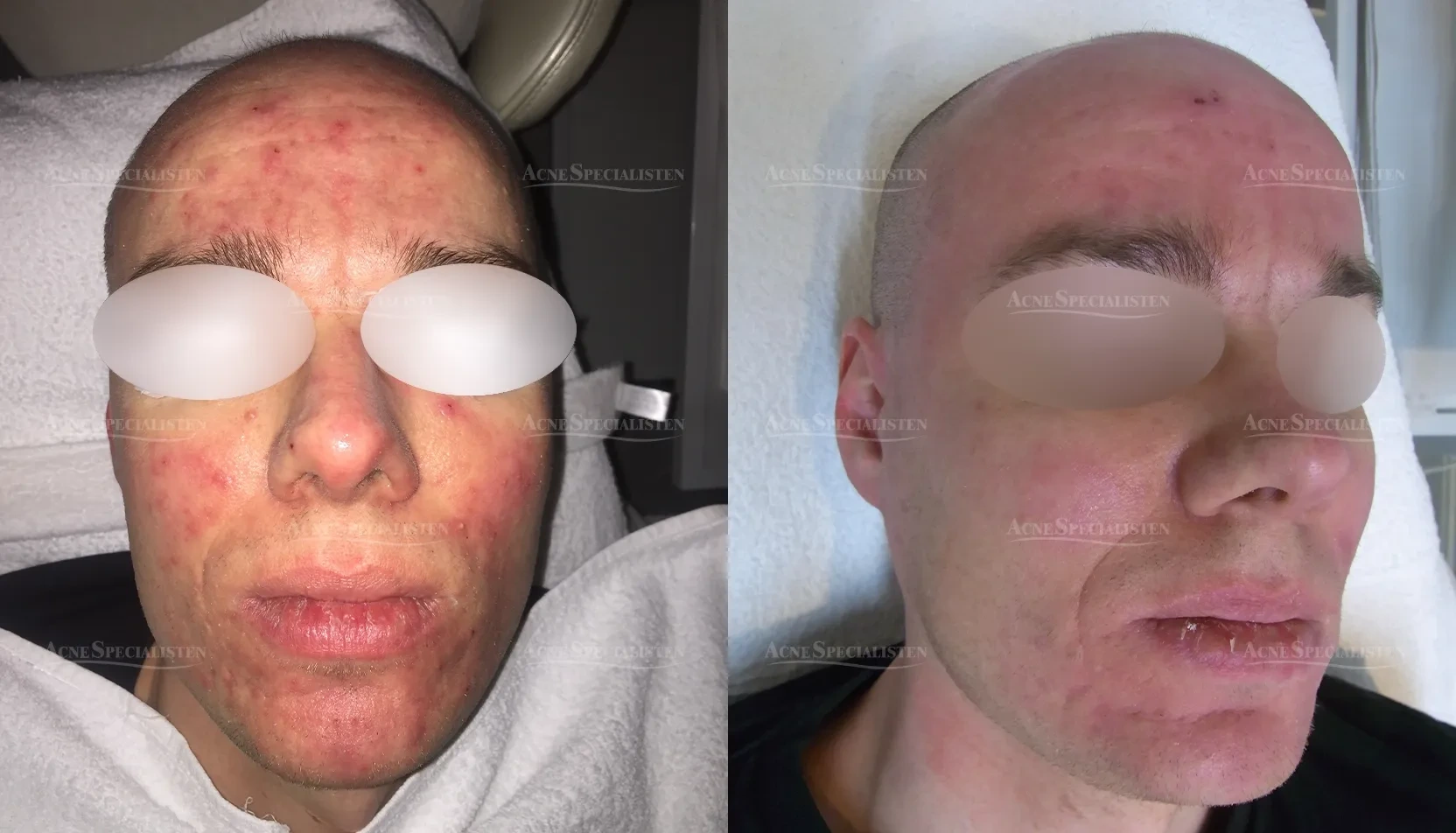 Rosacea med utslag före och efter behandling