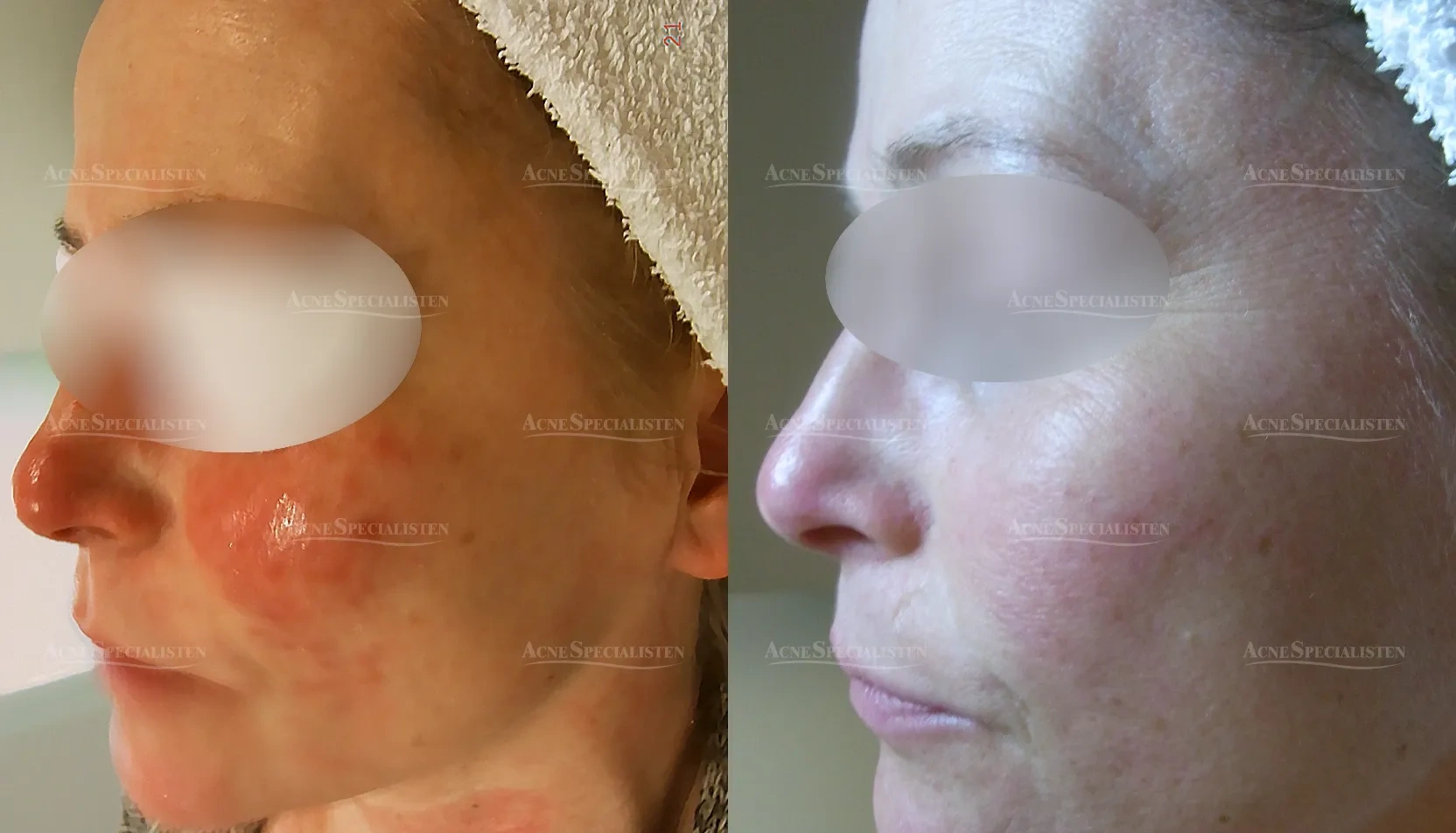 Rosacea på kinden före och efter behandling