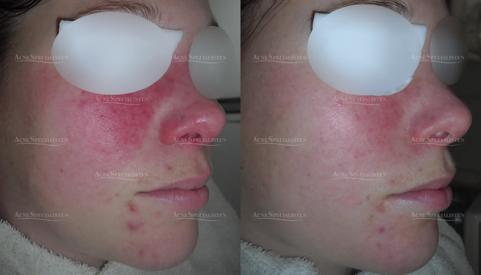 Rosacea på kinder och näsa med rodnad före och efter behandling