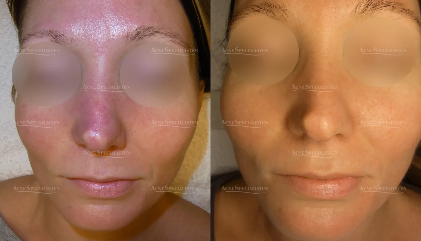 Lätt rosacea i ansiktet före och efter behandling