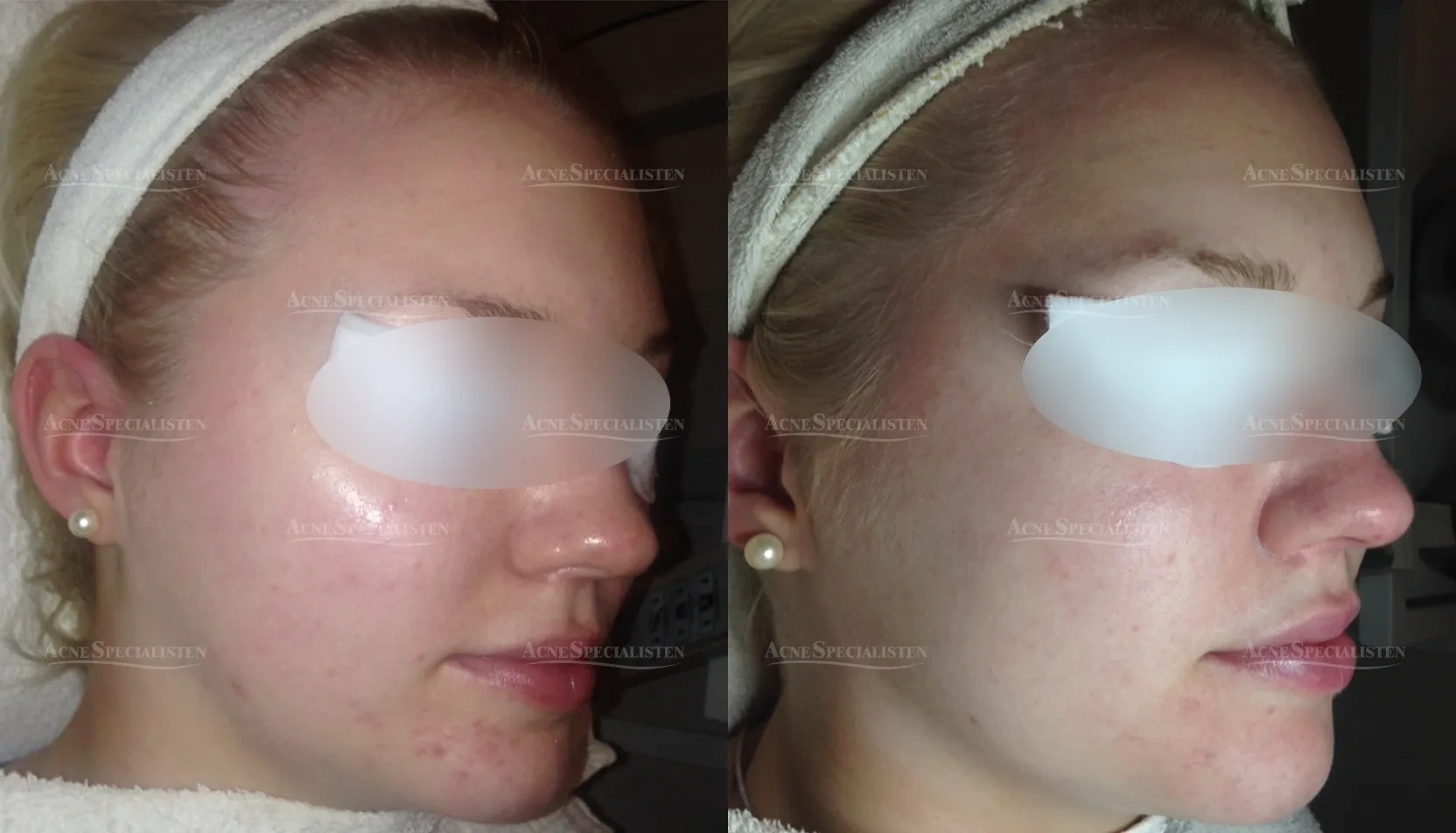 Lätt rosacea på hakan före och efter behandling