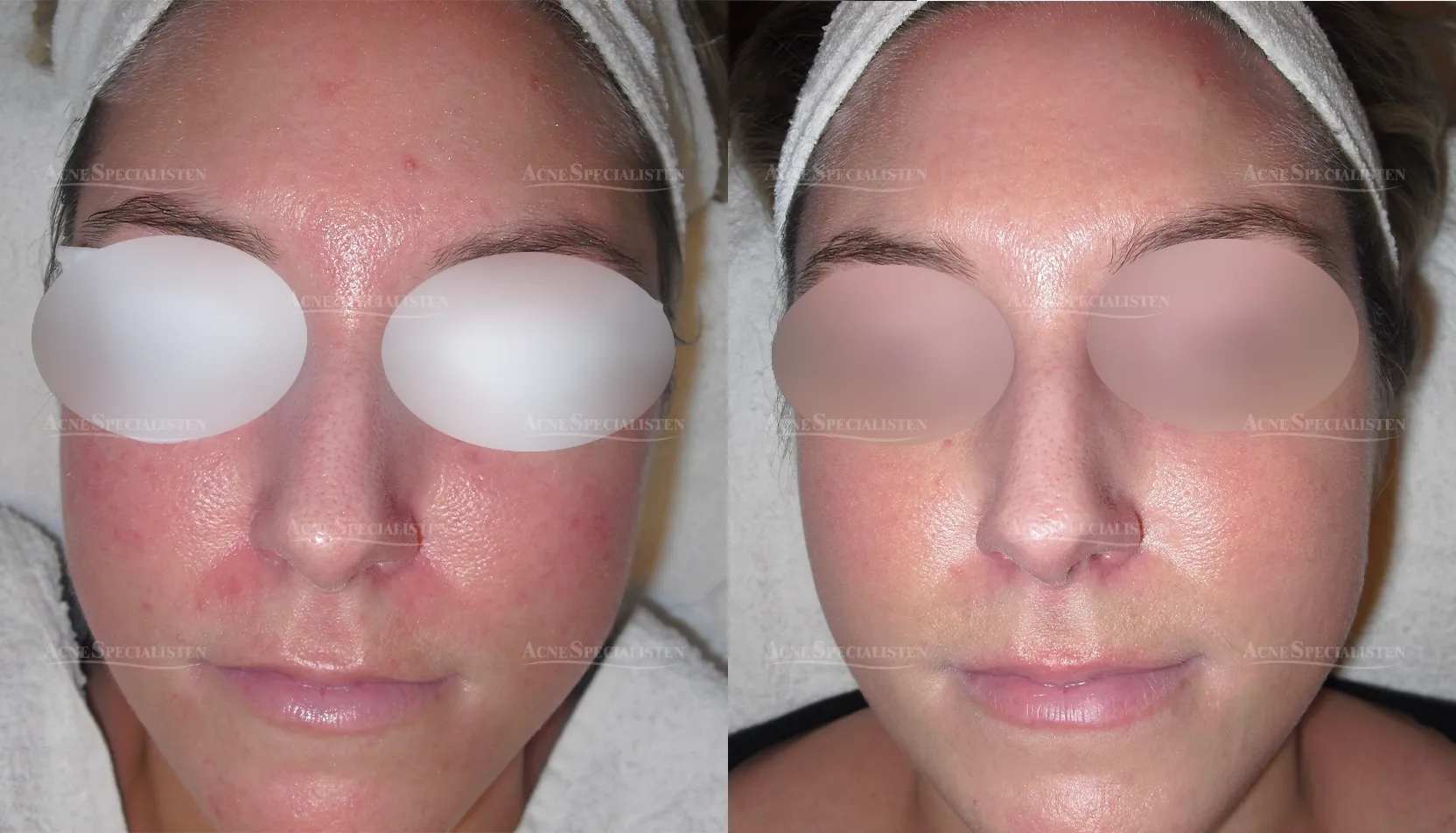 Rosacea på näsvingarna före och efter behandling