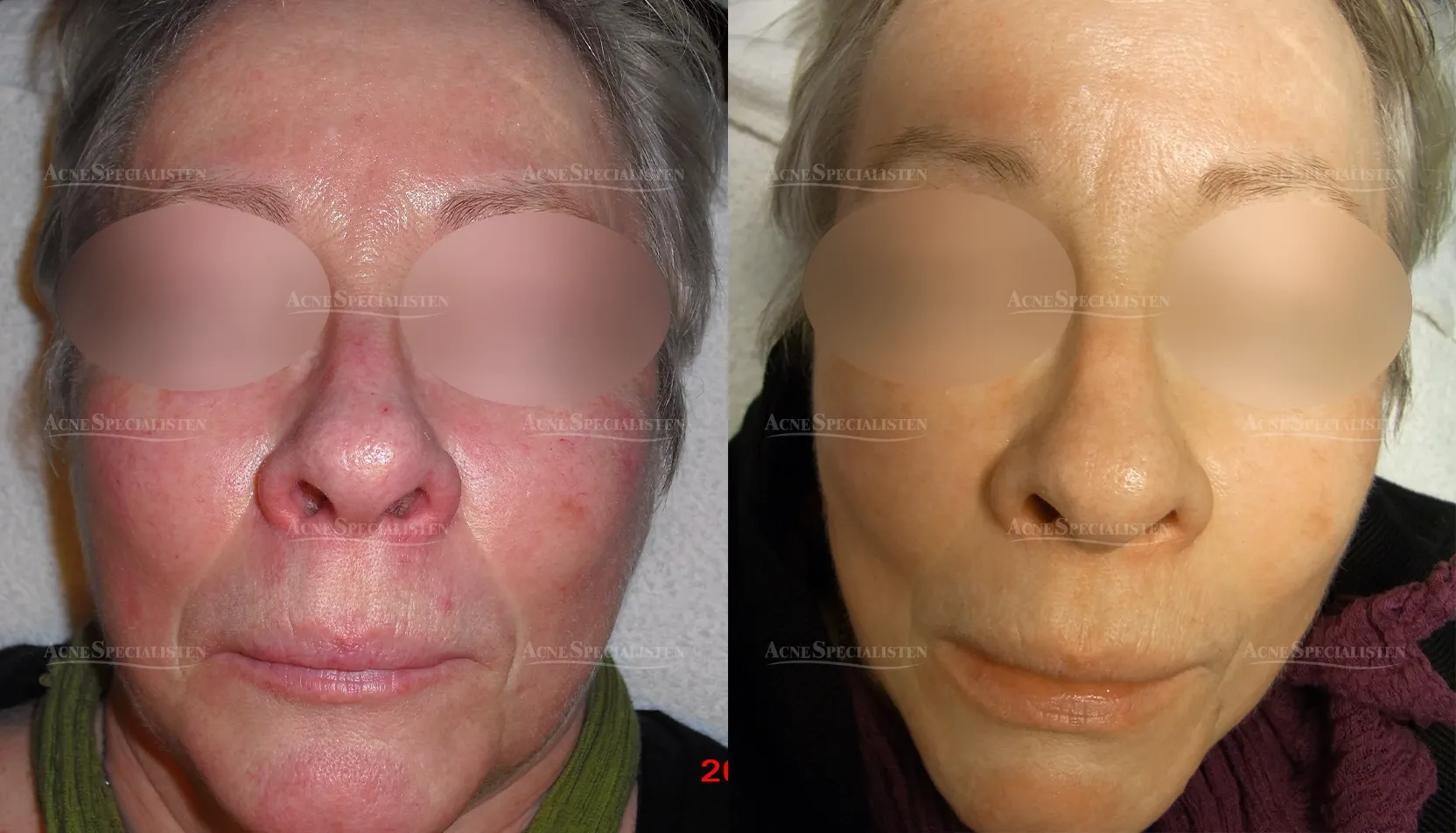 Omfattande rodnad från rosacea före och efter behandling