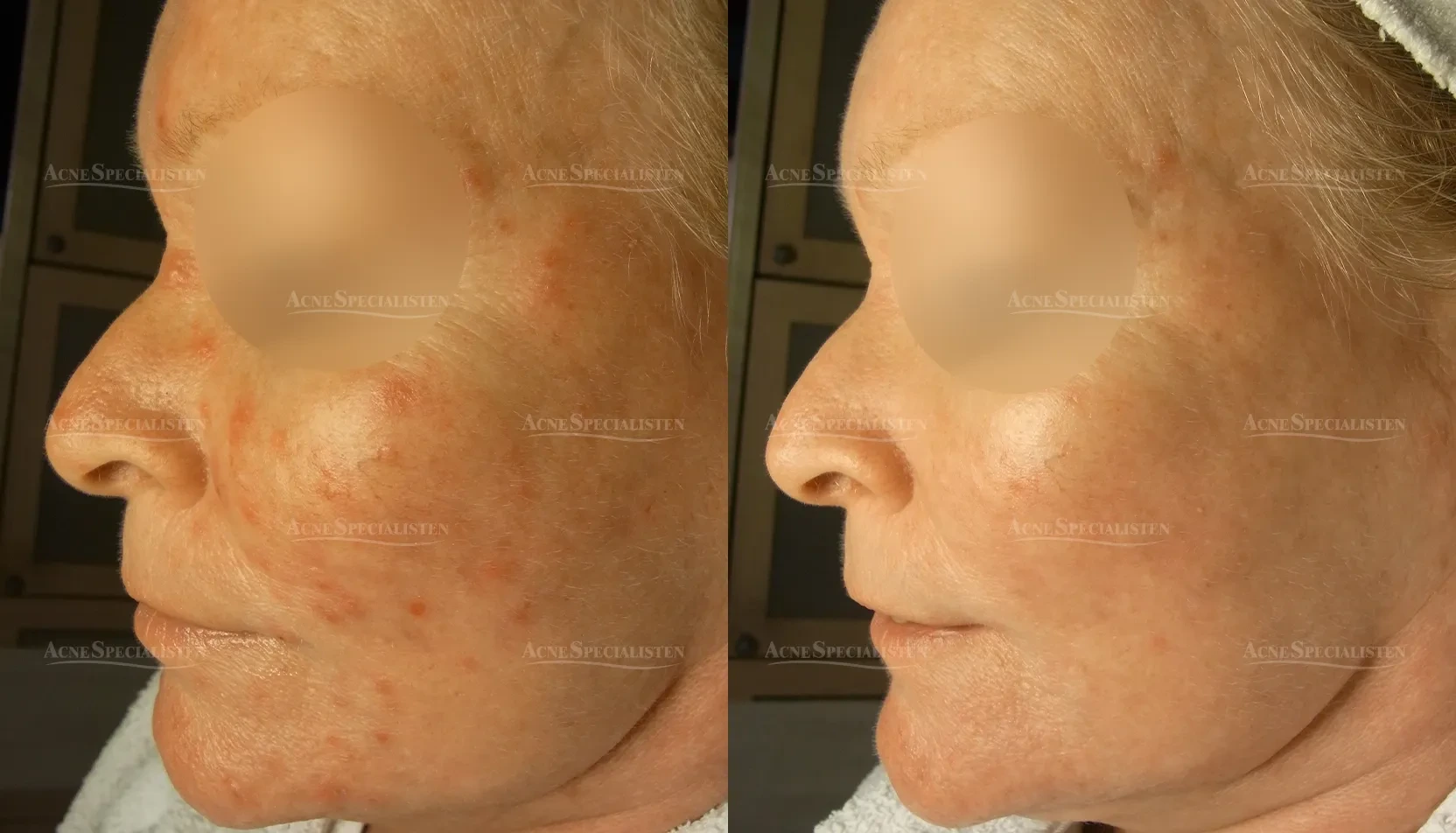 Prickar från rosacea före och efter behandling
