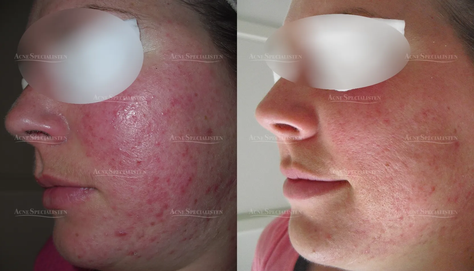 Rött ansikte från rosacea före och efter behandling