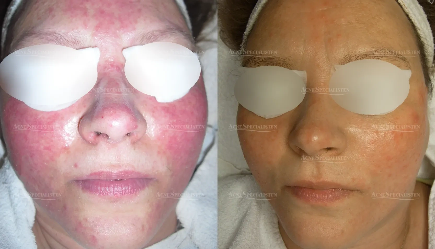 Svår rosacea i ansiktet före och efter behandling