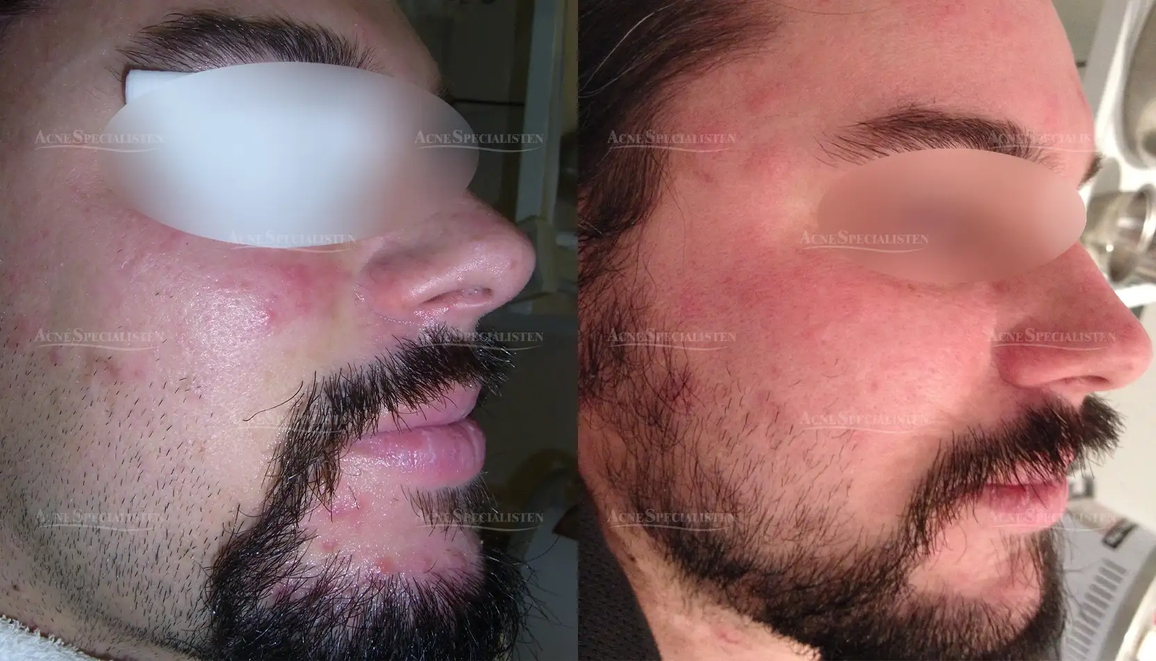 Utslag från rosacea före och efter behandling