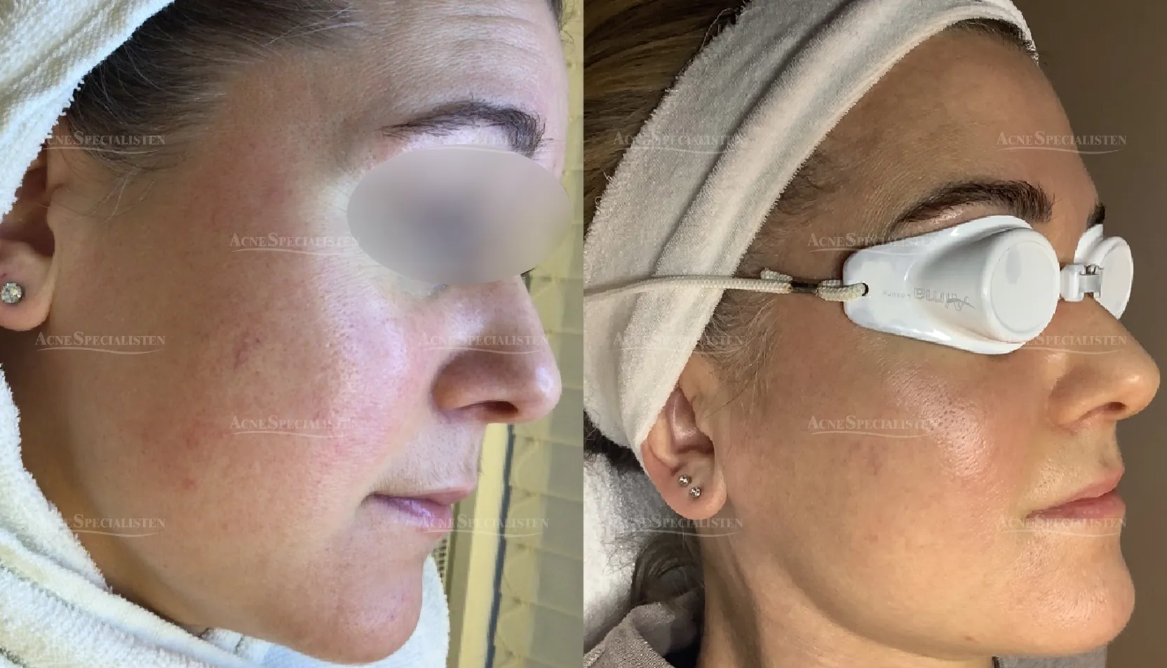 Ytliga blodkärl höger sida före och efter behandling