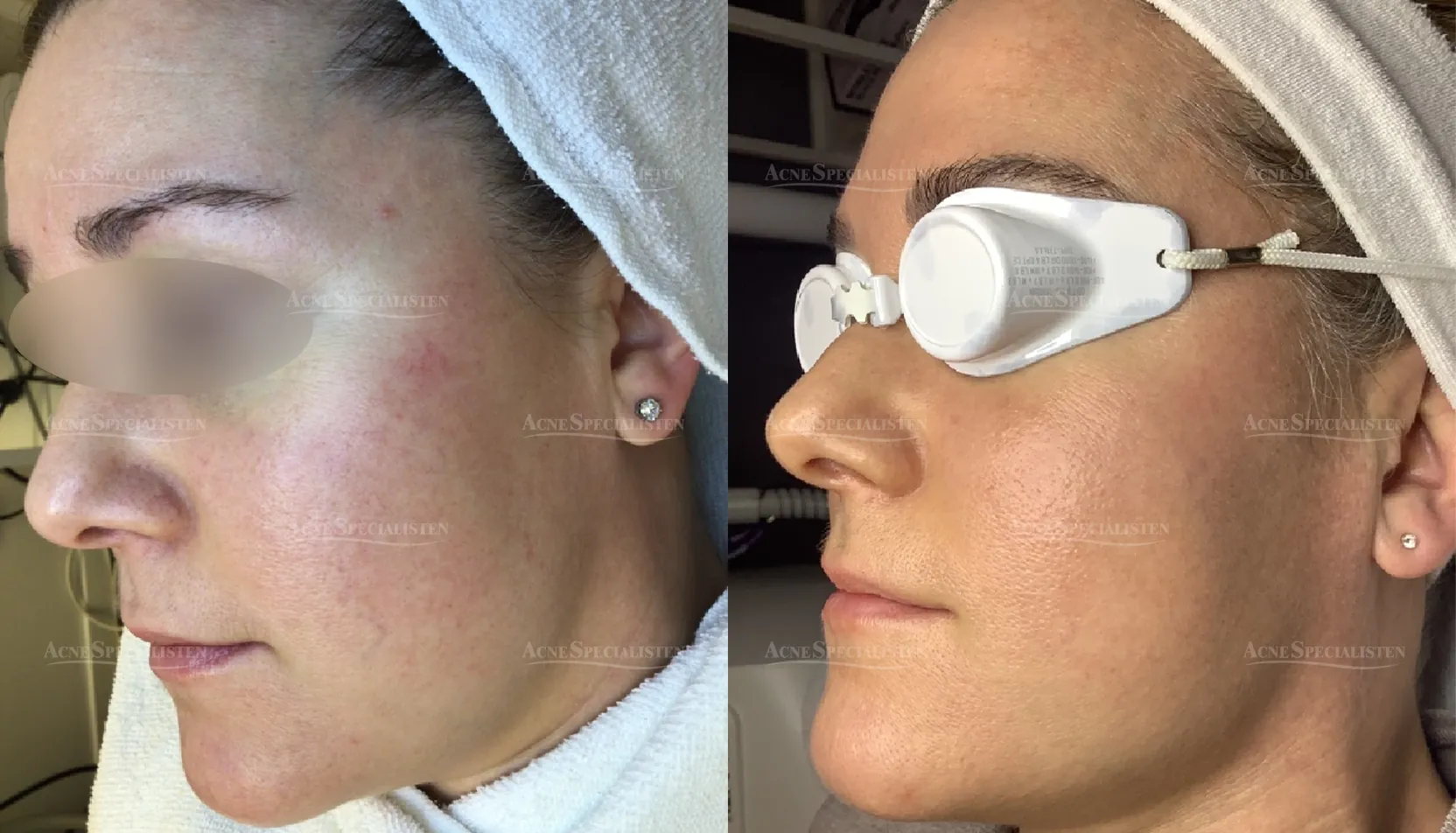 Ytliga blodkärl vänster sida före och efter behandling