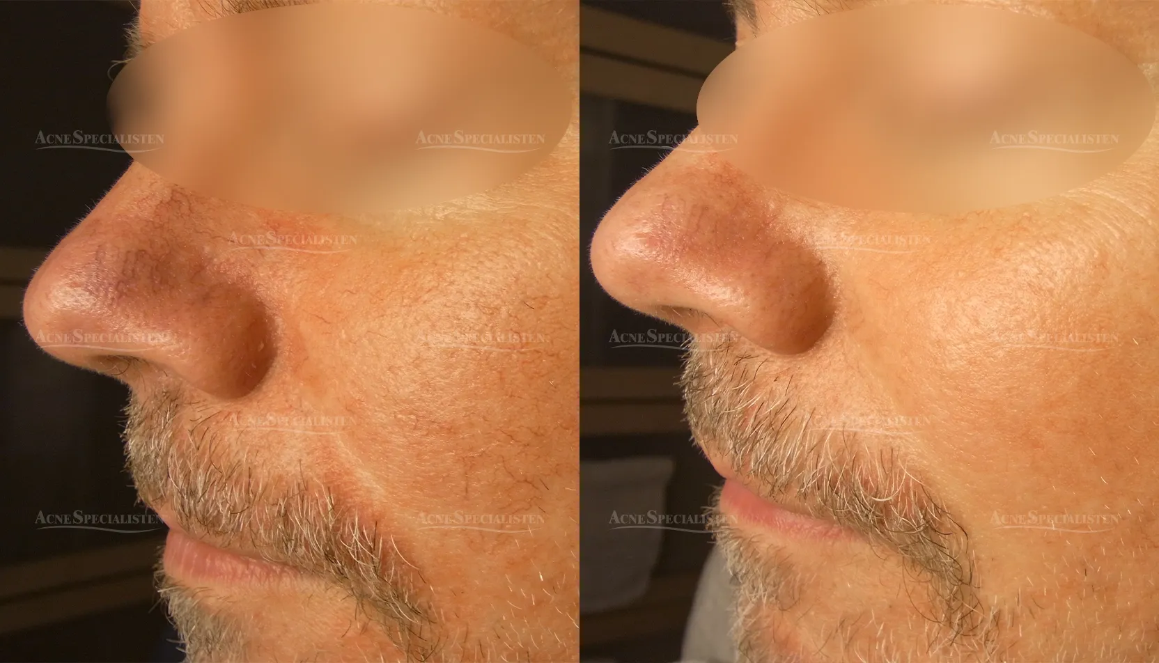 Ytliga blodkärl i ansiktet före och efter behandling