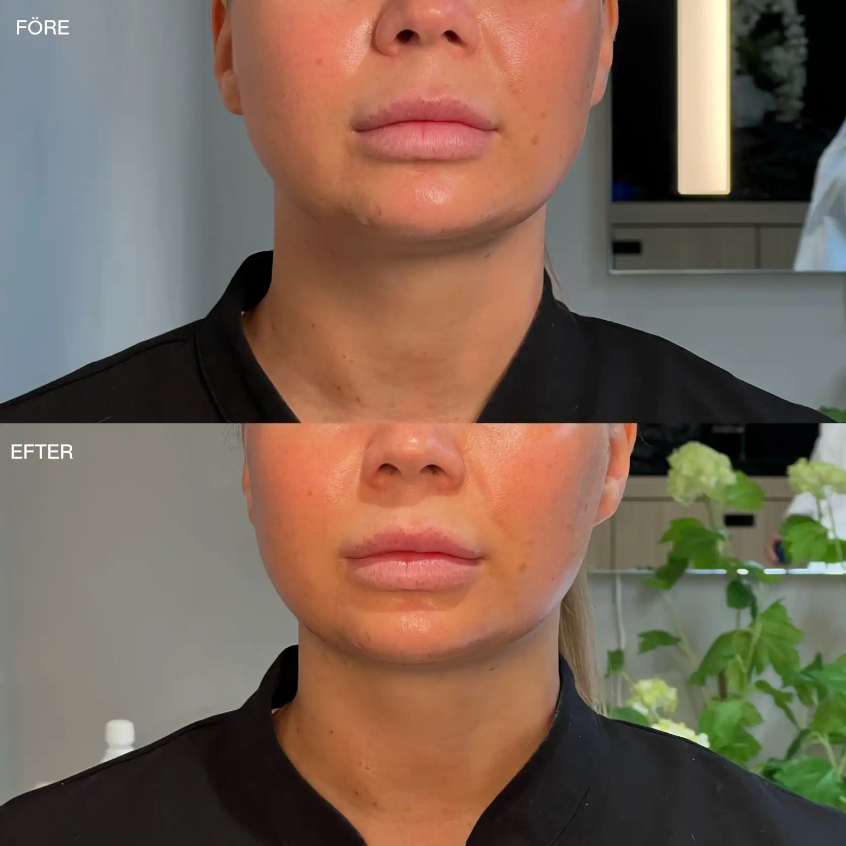Hals och käklinje framifrån före och efter HIFU