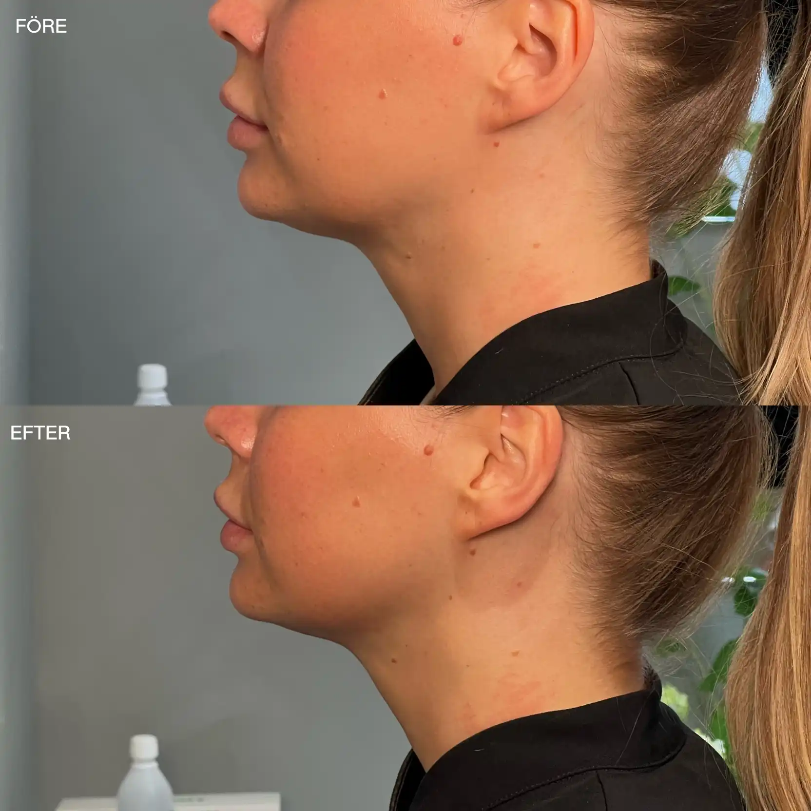 Hals i profil före och efter HIFU