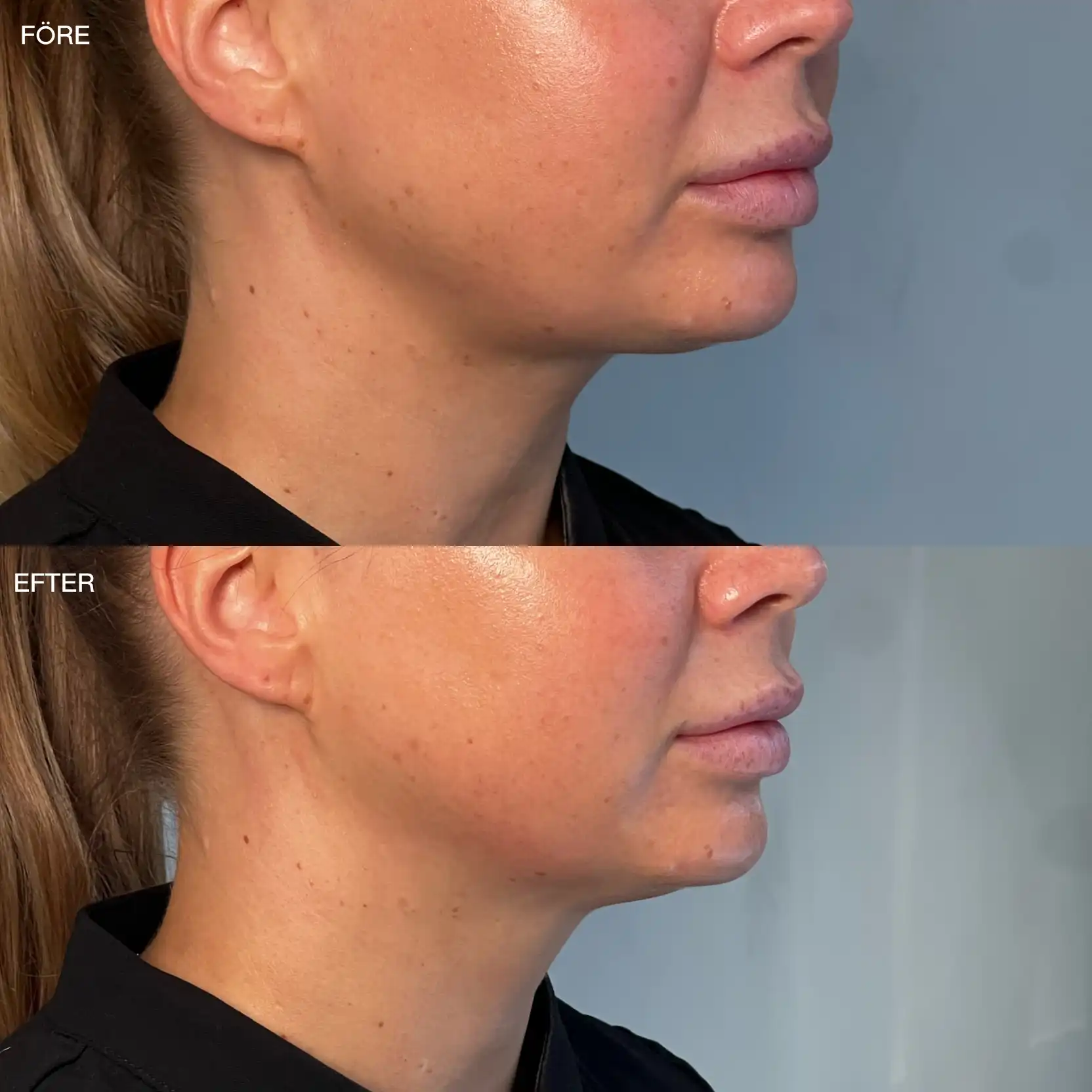 Närbild på käklinje före och efter HIFU