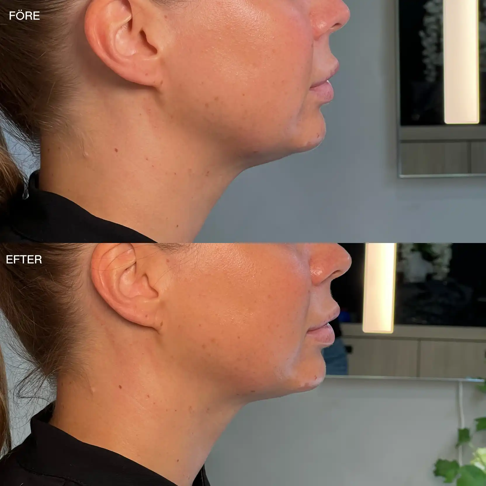 Käklinje i profil före och efter HIFU