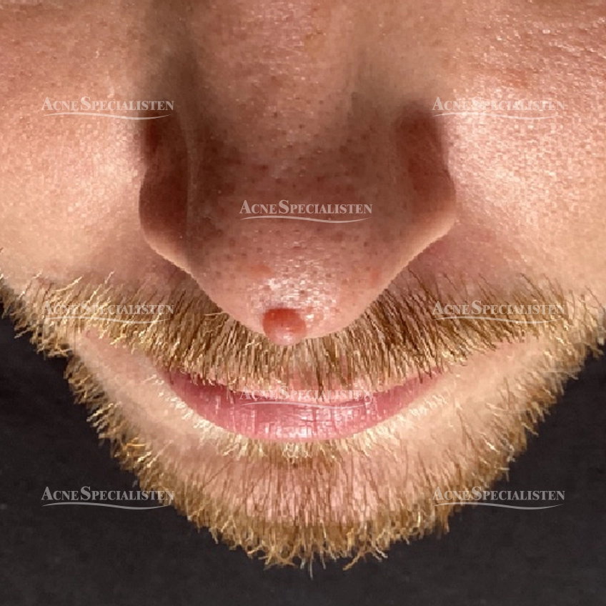 Före