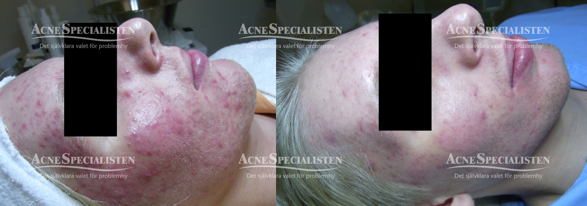 acne kund före och efter bilder