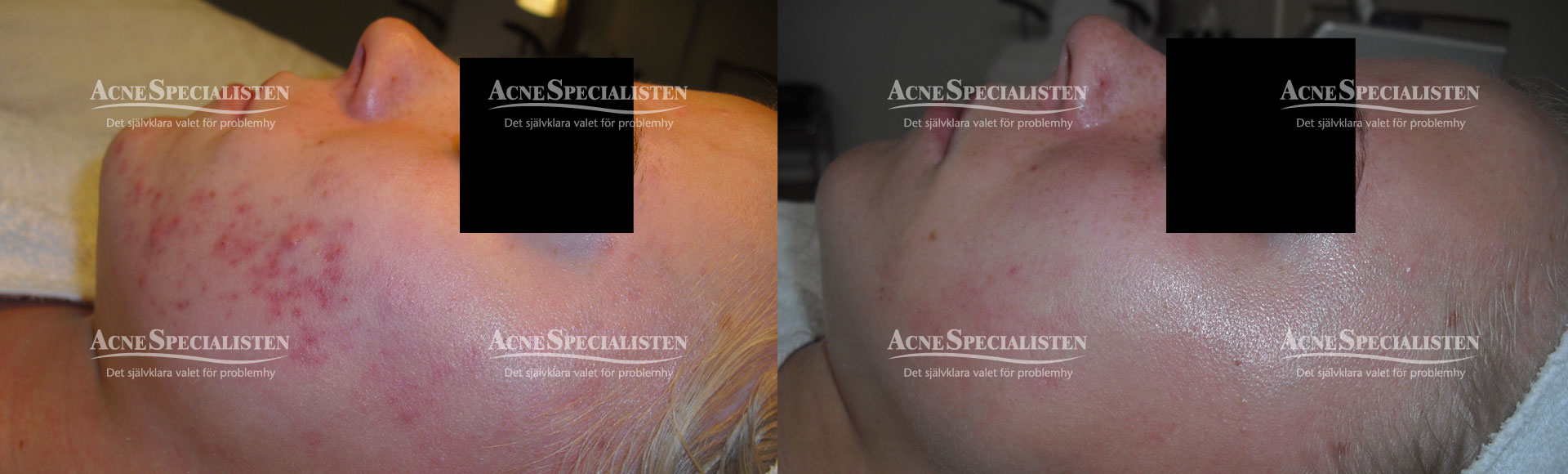 acne kund före och efter bilder
