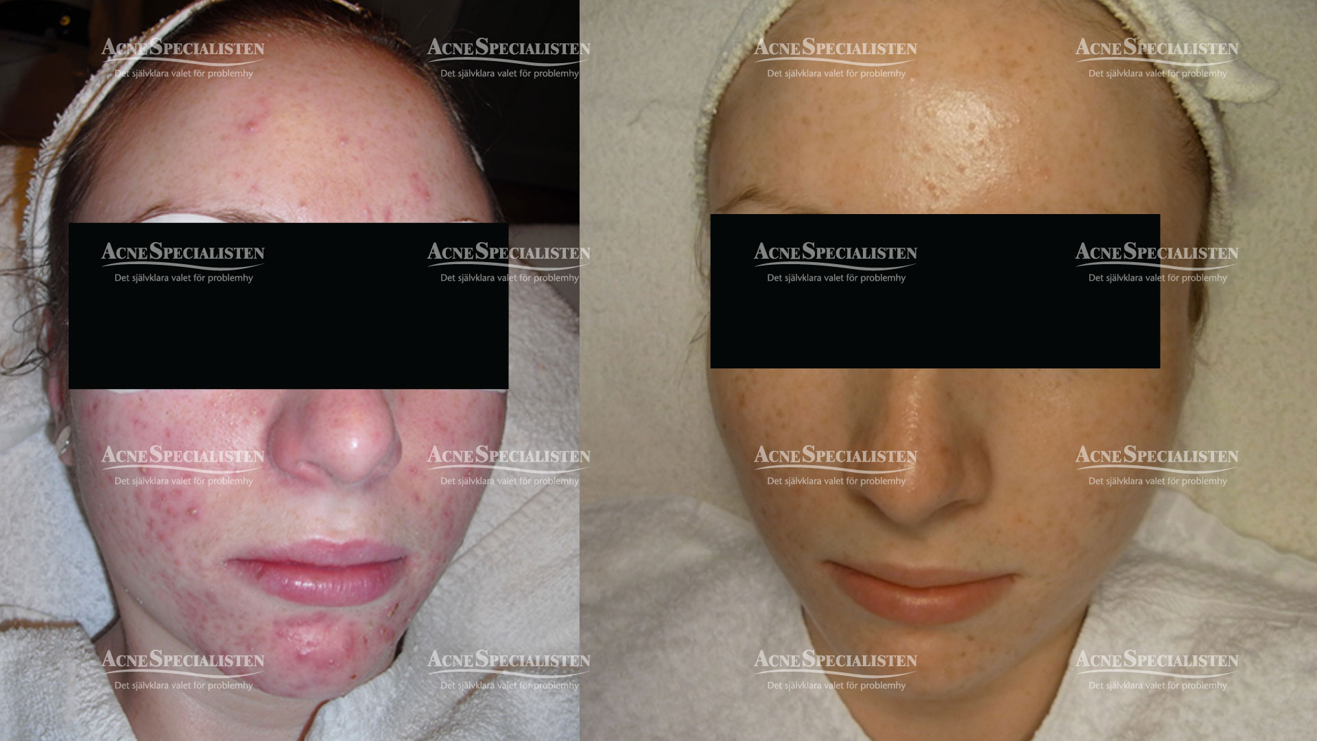 acne kund före och efter bild