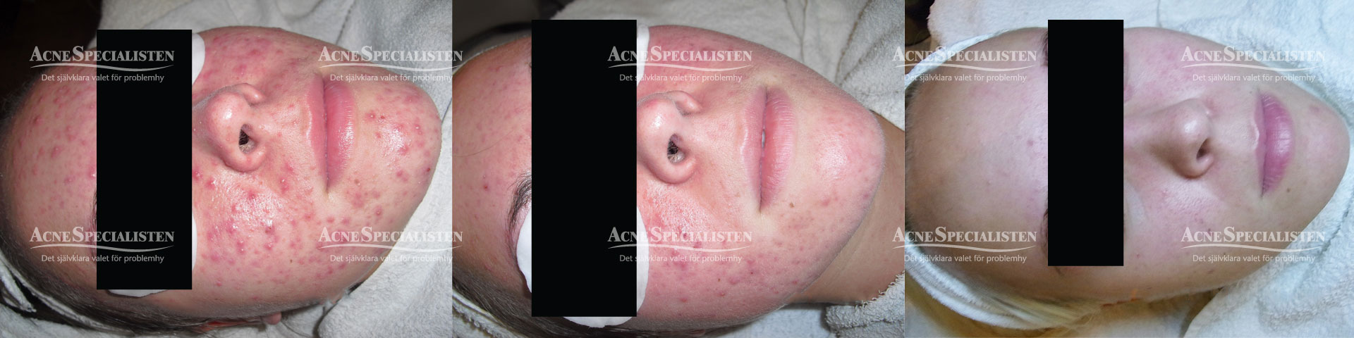 acne före och efterbilder
