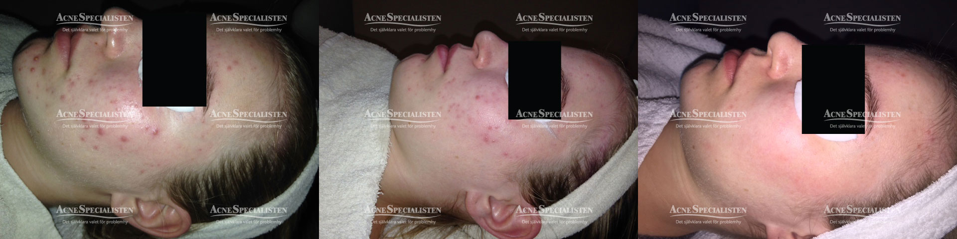 före och efter bilder acne på huden
