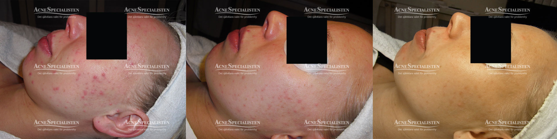 blandhy acne finnar före och efter bilder